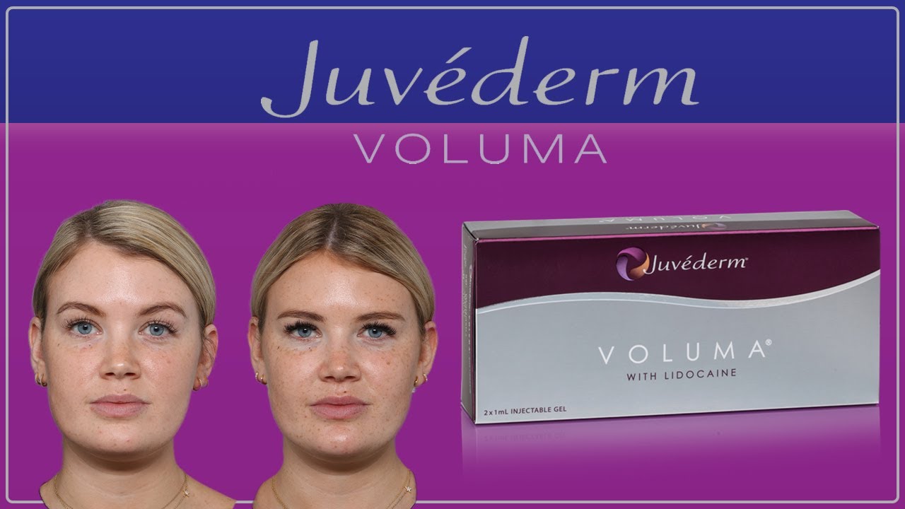 Cheek Filler Juvederm Voluma With Before and Afters