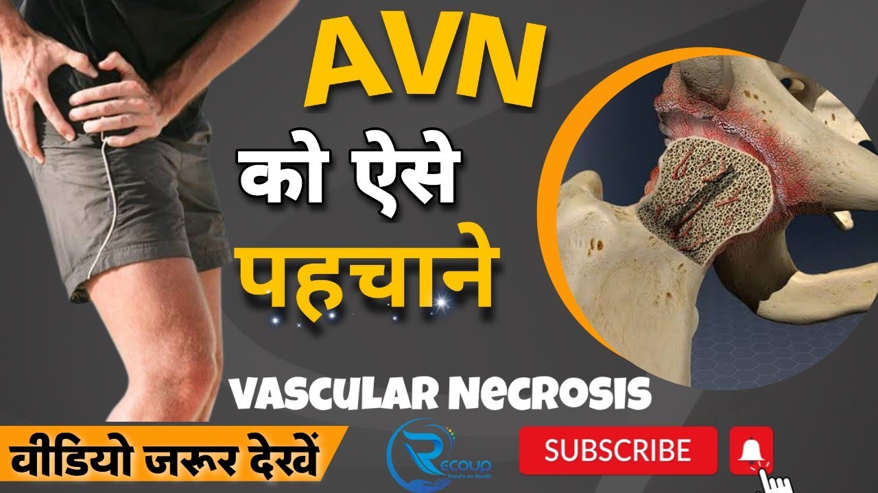 AVN hip ko kese pehchane. AVN hip Treatment without surgery. कुल्हे का दर्द  