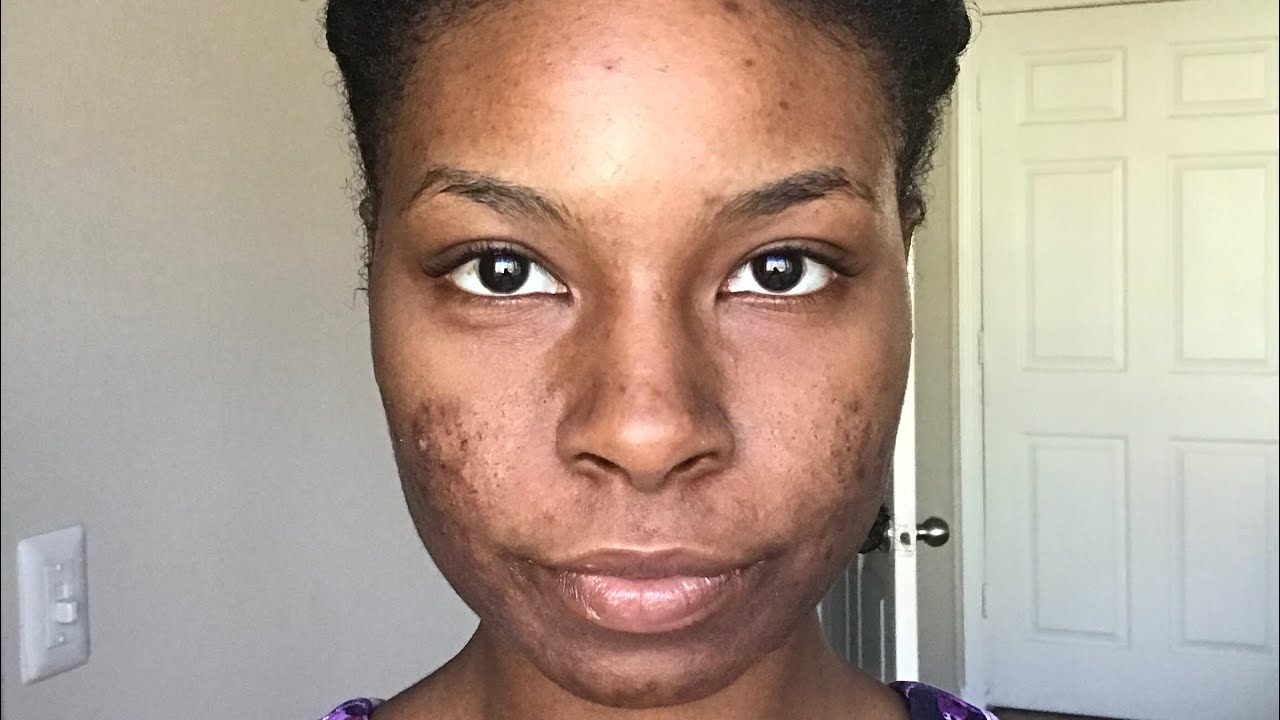 My Journey To Clear Skin - Raw Vegan Diet #1
