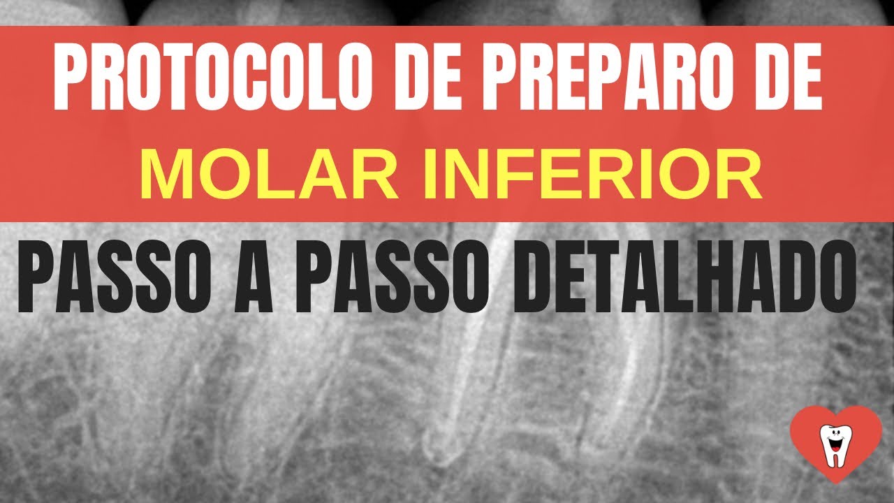 PREPARO DOS CANAIS DE MOLAR INFERIOR [PASSO A PASSO DETALHADO]
