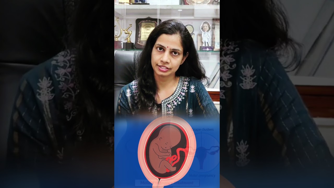 Treatment for a Molar Pregnancy | Dr. Nisha Mangal Explains | Molar Pregnancy |