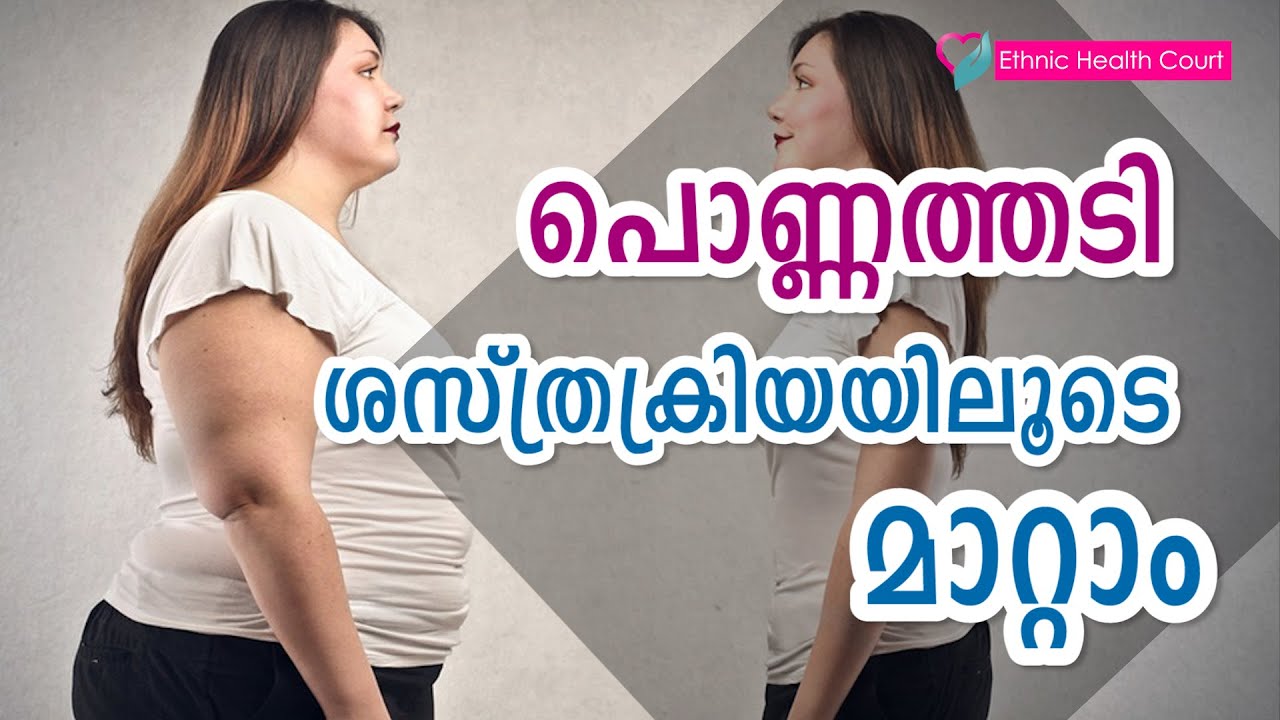 പൊണ്ണത്തടി ശസ്ത്രക്രിയയിലൂടെ മാറ്റം | Change through obesity surgery | Ethnic Health Court