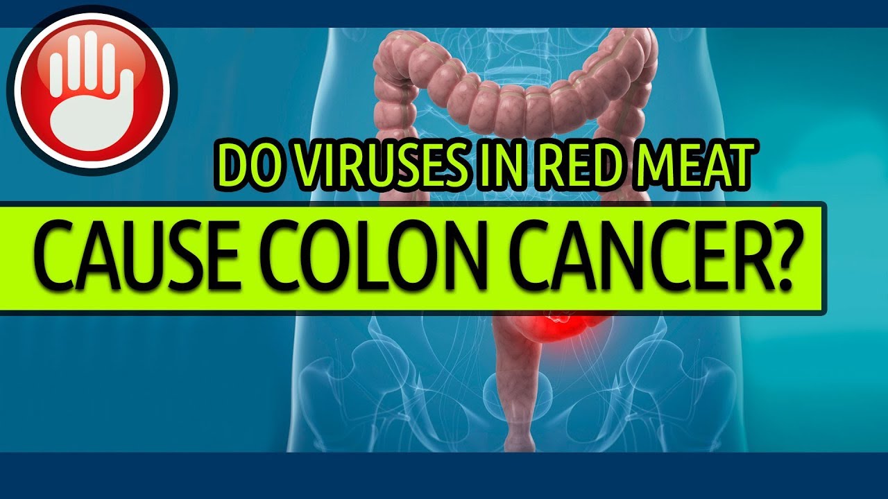 Do Viruses in Red Meat Cause Colon Cancer?