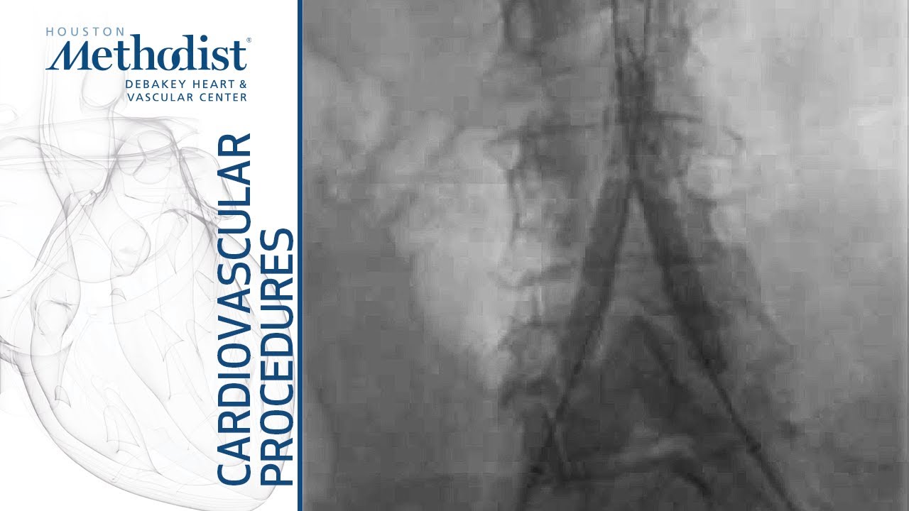 Kissing-Stenting Technique for Aorta-Iliac Lesions (Maham Rahimi, MD, PhD, Tarundeep Singh, MD)