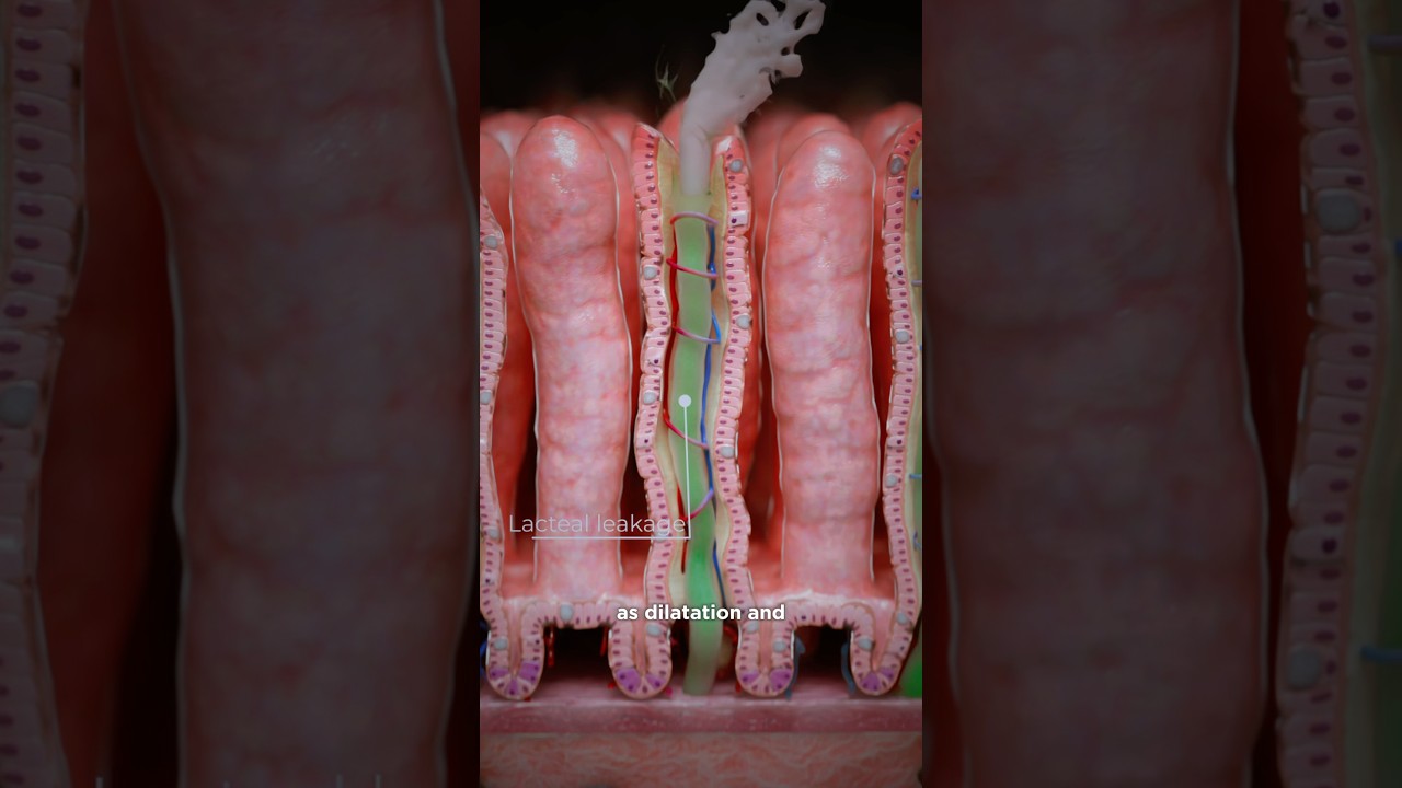 What happens after the Fontan procedure and why can it lead to protein-losing enteropathy? Part 1