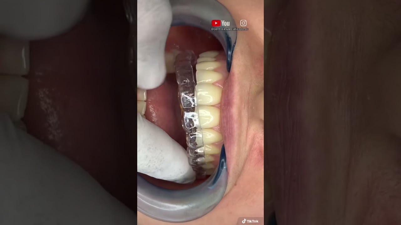 &iexcl;Despu&eacute;s de los BRACKETS vienen los retenedores invisibles!
