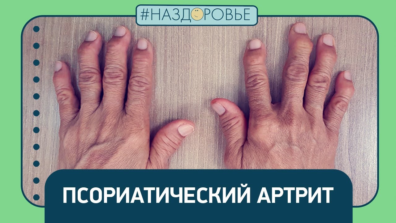 #НАЗДОРОВЬЕ: псориатический артрит