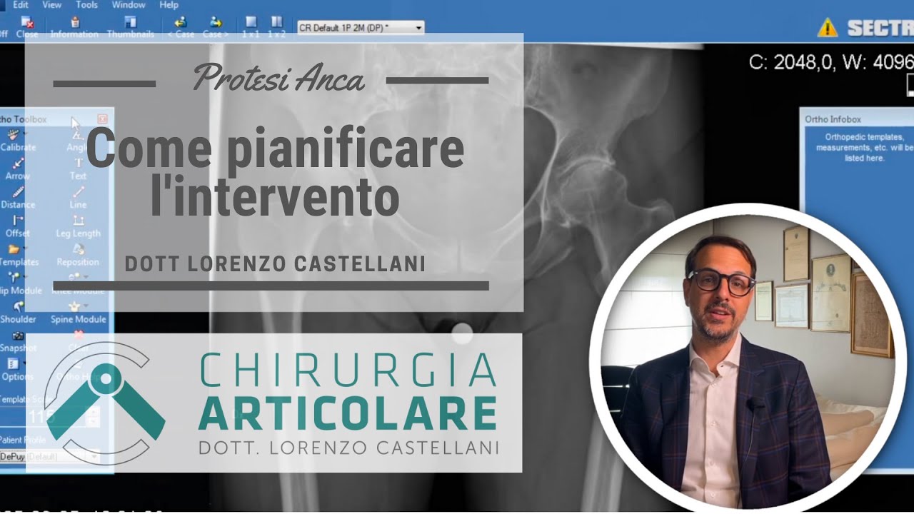 Pianificazione prima di intervento protesi anca: come si fa?