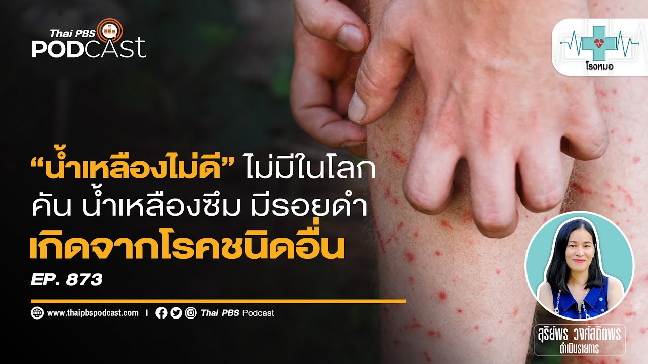 น้ำเหลืองเสีย คำฮิตติดปากที่ไม่มีอยู่จริงในทางการแพทย์ แต่เกิดจากโรคและแบคทีเรีย | โรงหมอ