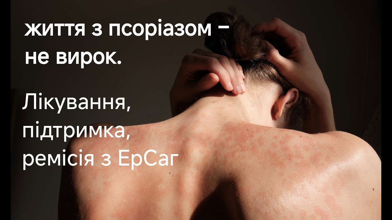 Псоріаз. Лікар вищої категорії  Валентина Іванівна Барановська, Лідер компанії ЕрСаг