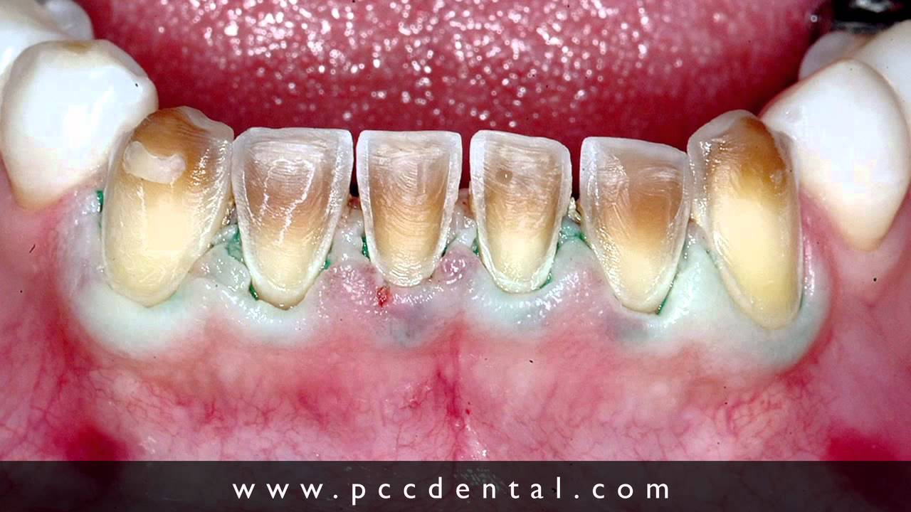 Ask Gordon: Can you successfully bleach tetracycline stains?