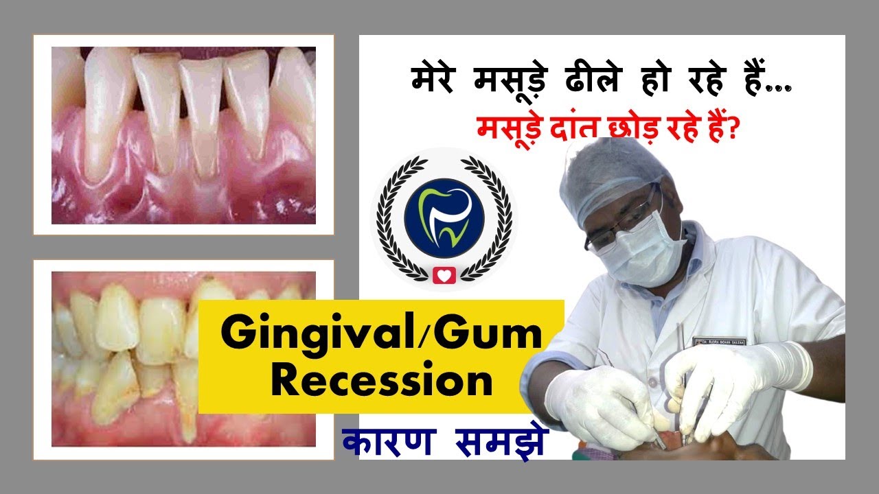 Dr Rudra Mohan | मसूड़े दांत छोड़ रहे हैं?| Gingival/Gum Recession - Causes and Prevention!