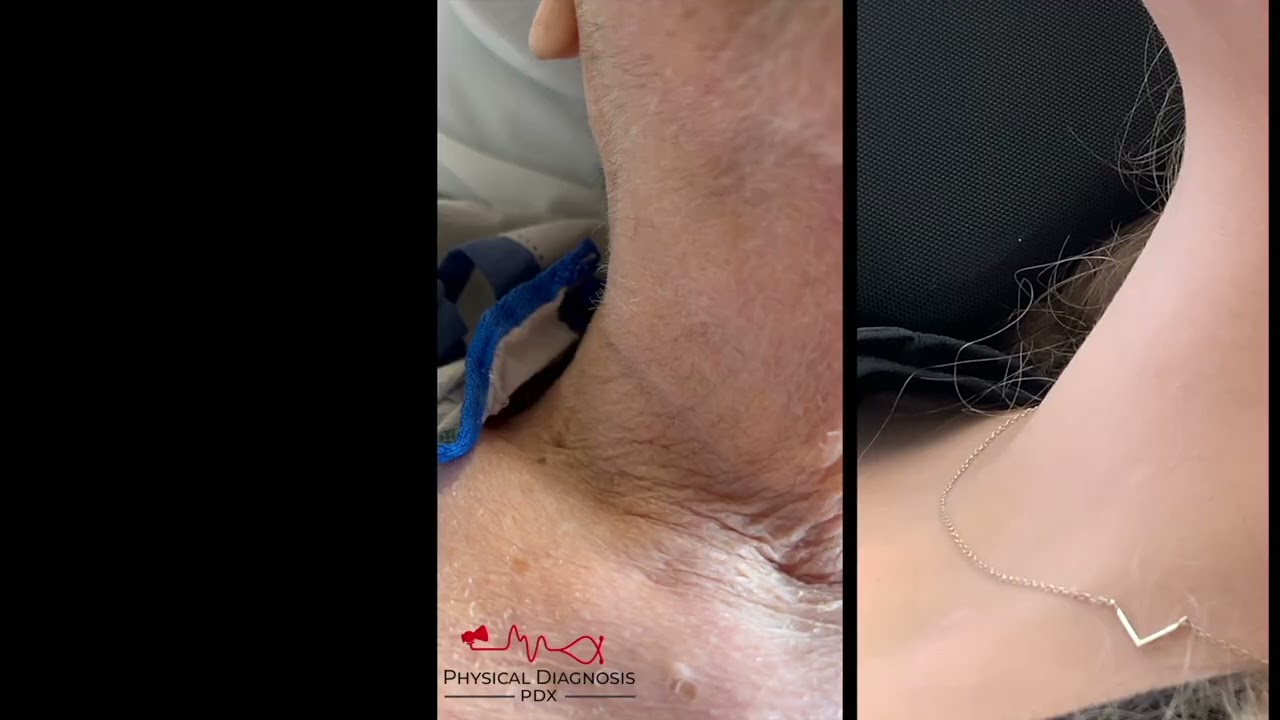 Corrigan’s Pulse in Aortic Regurgitation — Bounding Carotid Pulse Explained