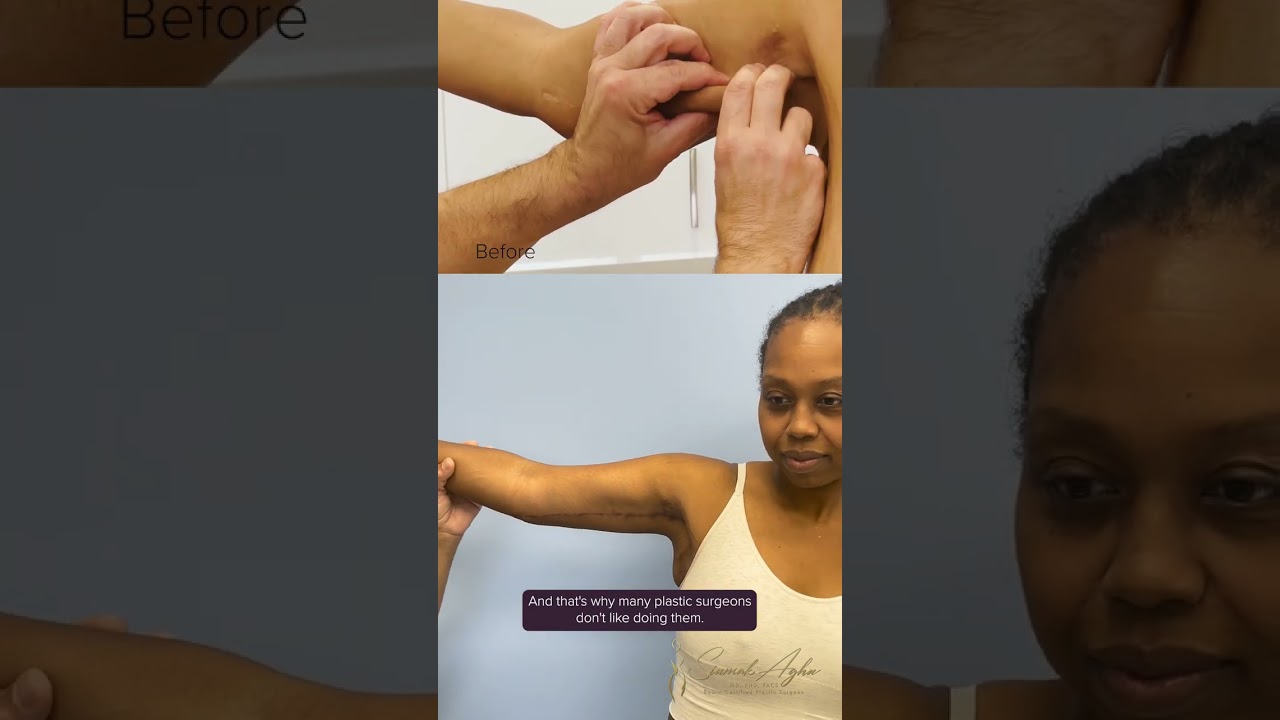 4 Months Post Op Arm Lift Redo 💪🏻