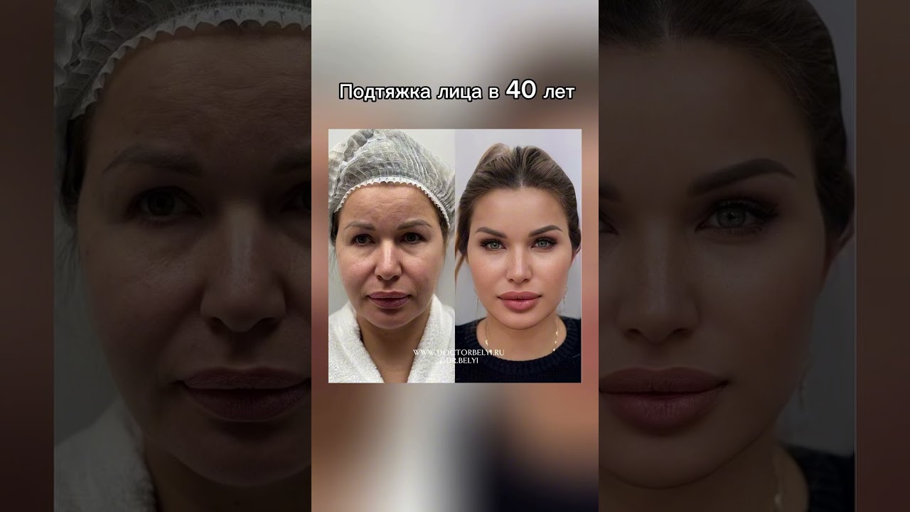 Before & After: Real Results, Natural Beauty Enhanced