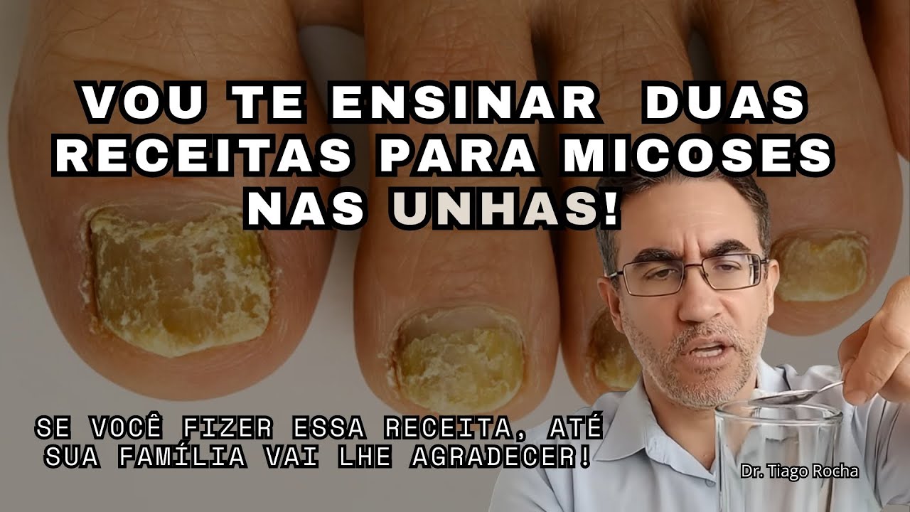 O MELHOR REMÉDIO CASEIRO DO MUNDO PARA MICOSE DE UNHA. "Dr. Tiago Rocha"