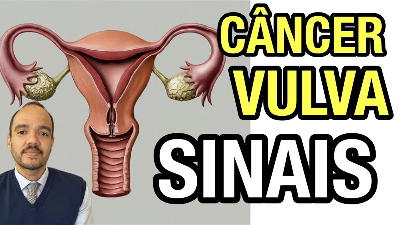 SINAIS E SINTOMAS INICIAIS DO CÂNCER DE VULVA