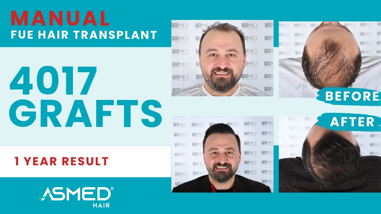 ASMED – Dr. Koray Erdogan – 4017 Grafts | 1 Year Results