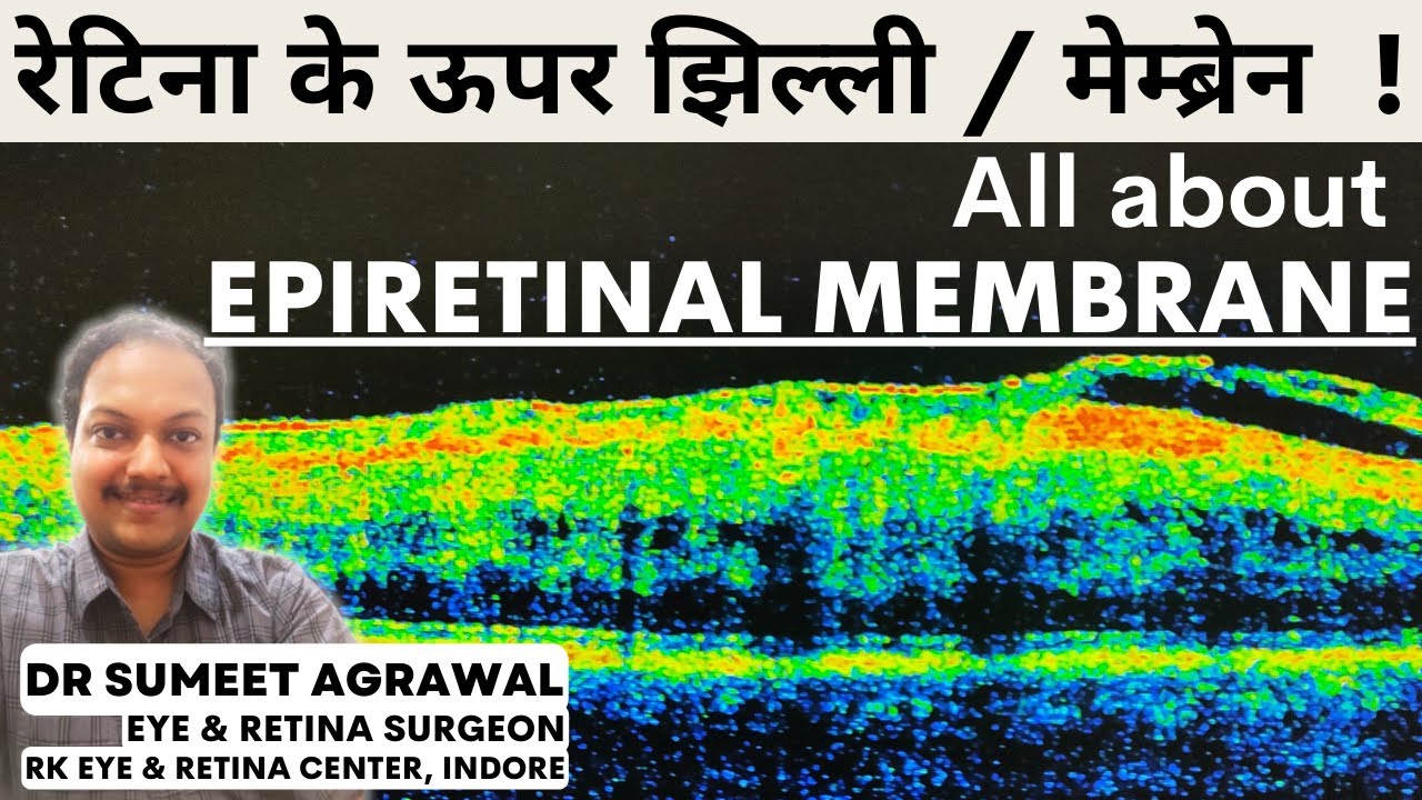 रेटिना के ऊपर झिल्ली / मेम्ब्रेन l  EPI-RETINAL MEMBRANE. रेटिना surgeon से जानिये लक्षण और इलाज l