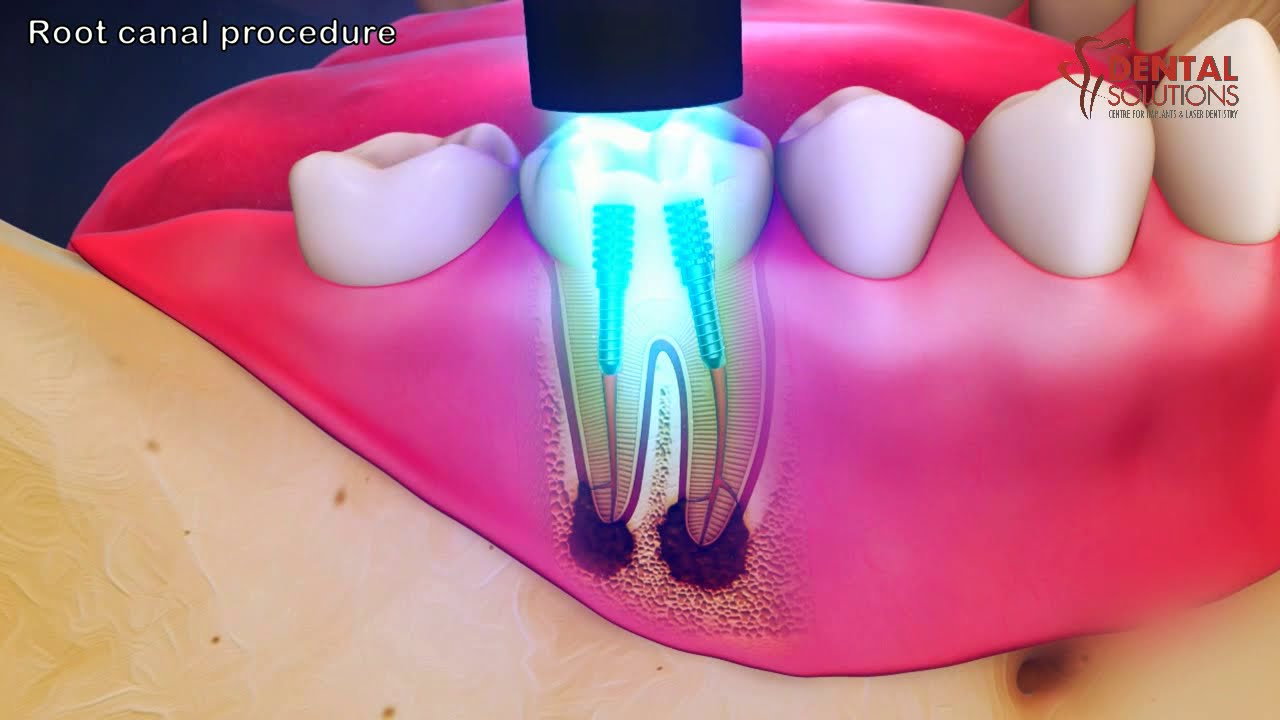 All you need to know about the Root canal procedure