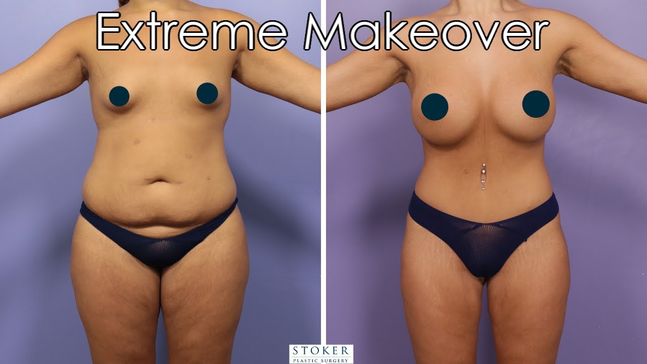 Extreme Makeover Plastic Surgery Los Angeles: Top Surgeon Dr. Stoker Transforms After Weight Loss