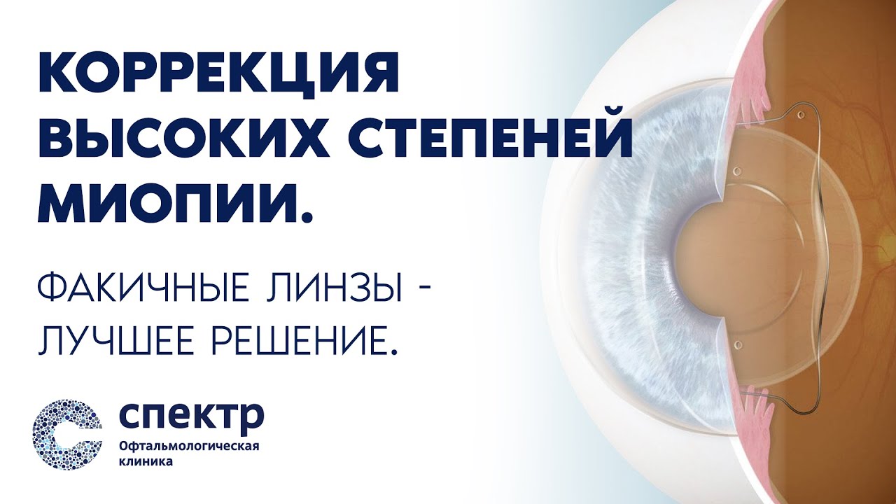 Коррекция зрения высоких степеней миопии - лучшее решение это факичные линзы.
