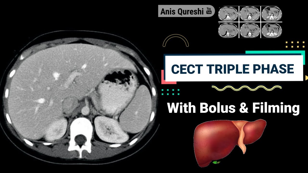CECT Triple Phase with Bolus Tracking and Filming| By Anis Qureshi