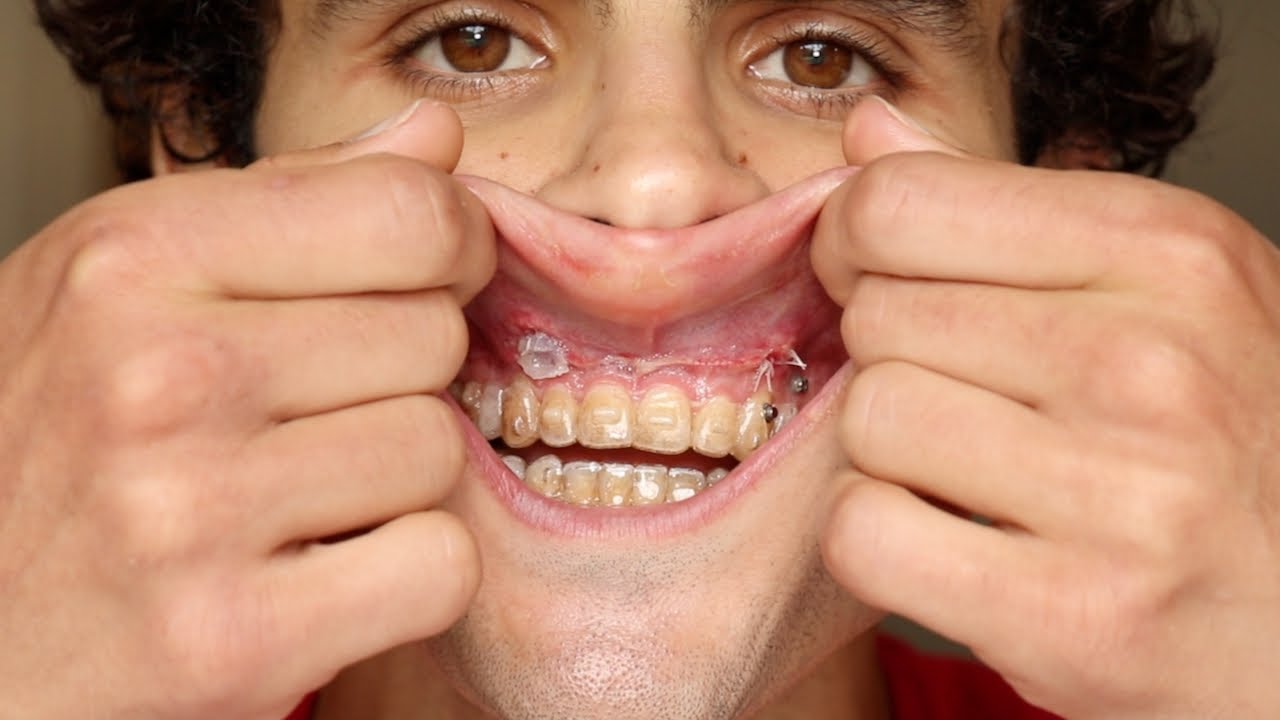 Bone Graft for Failed AGGA Case - 1 Week Later