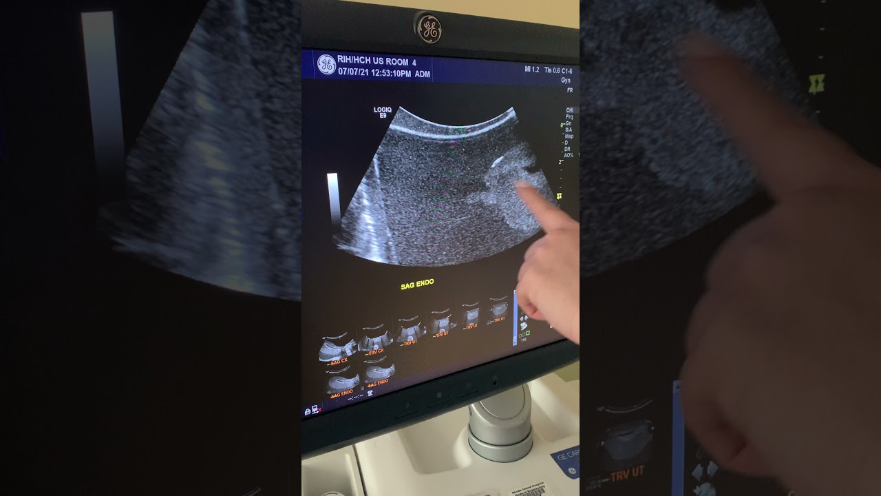 Pelvic transabdominal ultrasound for beginners