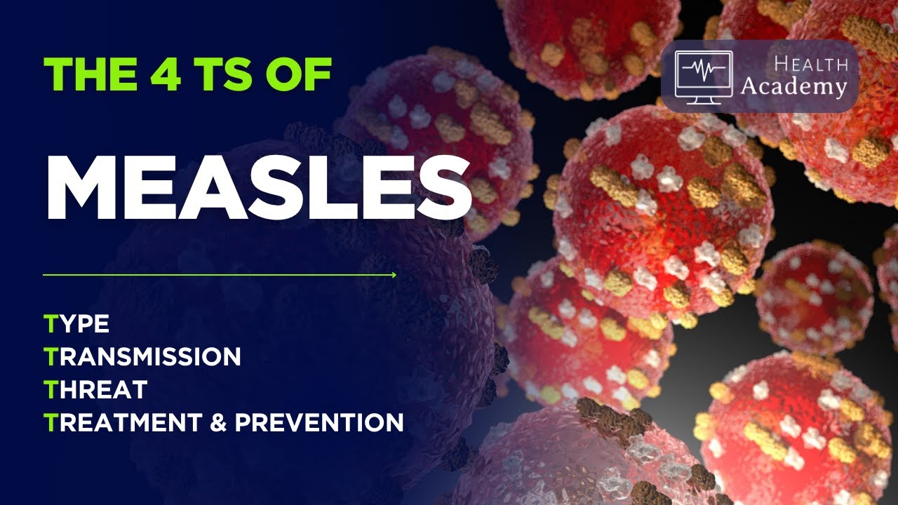 The 4T's of Measles