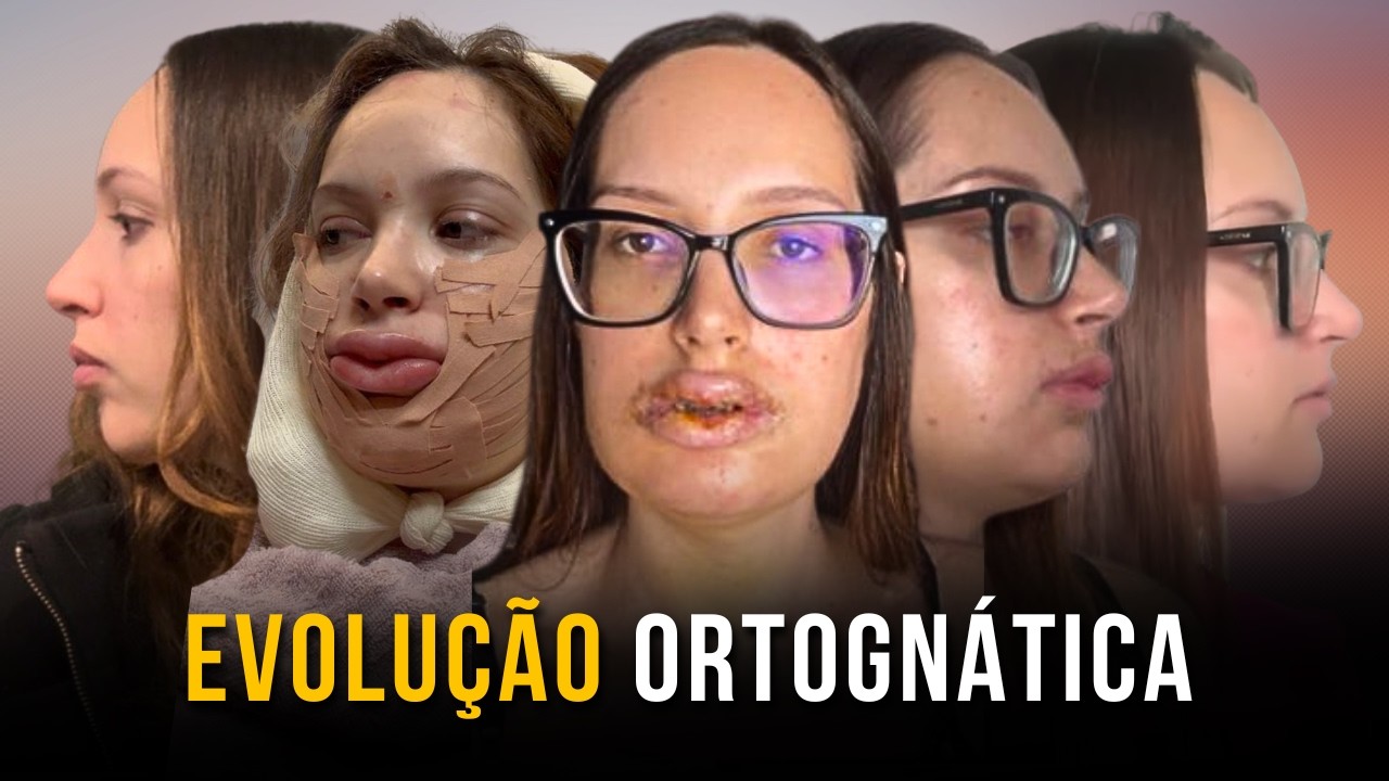 30 Dias P&oacute;s-Ortogn&aacute;tica: A Evolu&ccedil;&atilde;o do Meu Rosto
