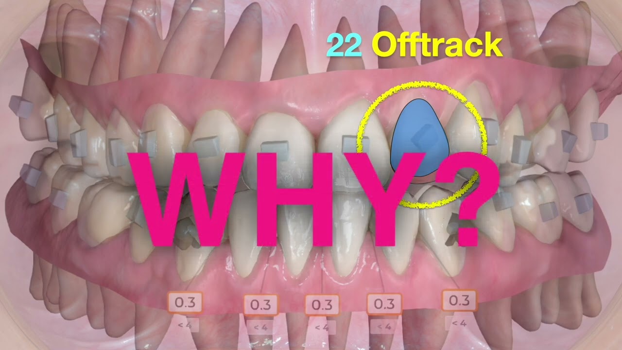 CIII Open bite with SPARK  |【Chris Chang Ortho】CC863