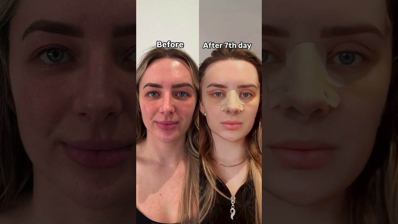 Cat Eye Surgery Before & After 👁️✨