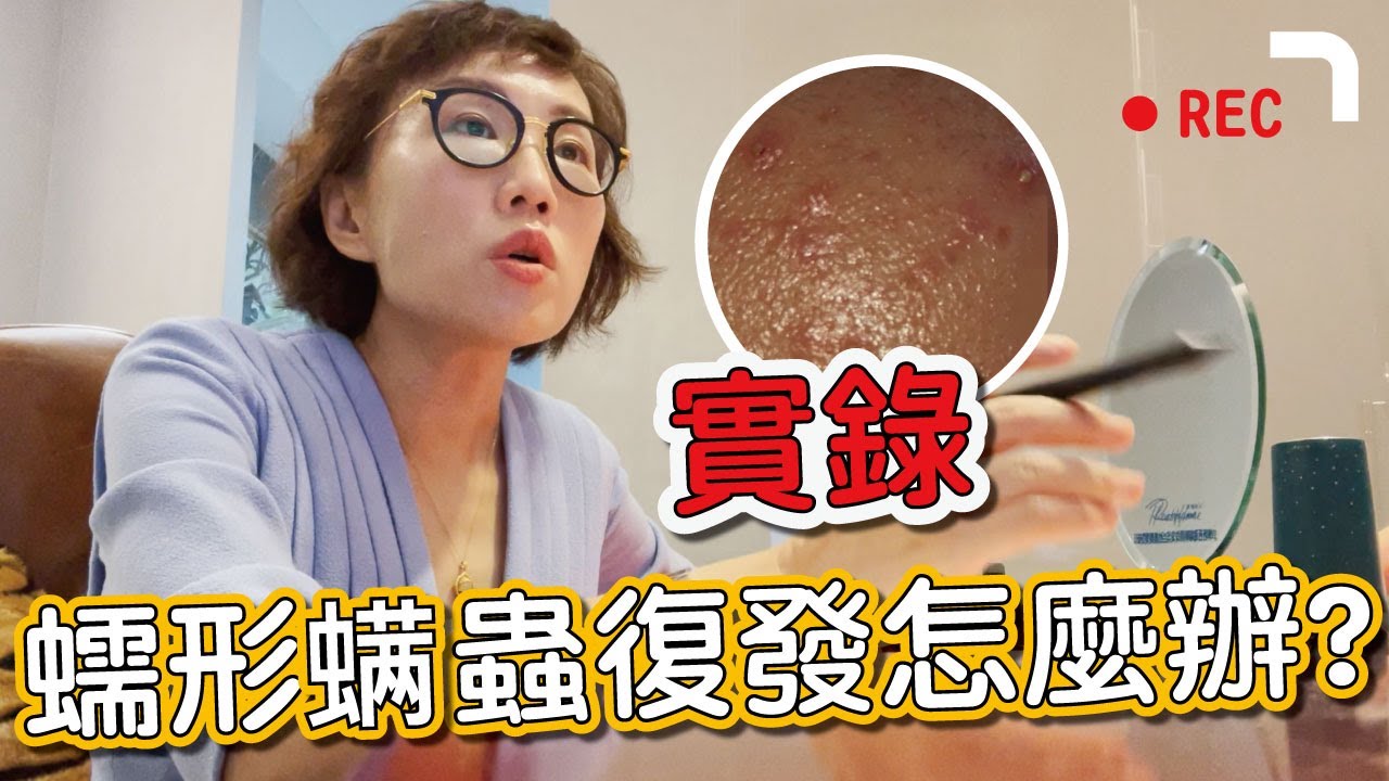 蠕形螨蟲又復發了好困擾！不想出門看醫生可以利用線上看診的方式跟莊盈彥醫師諮詢喔！
