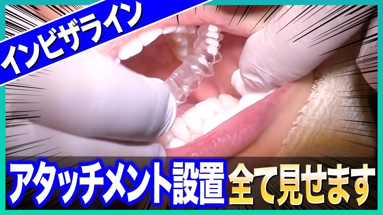 【密着】インビザラインアタッチメントの付け方を完全公開【マウスピース】 #インビザラインアタッチメント #インビザライン #インビザライン矯正