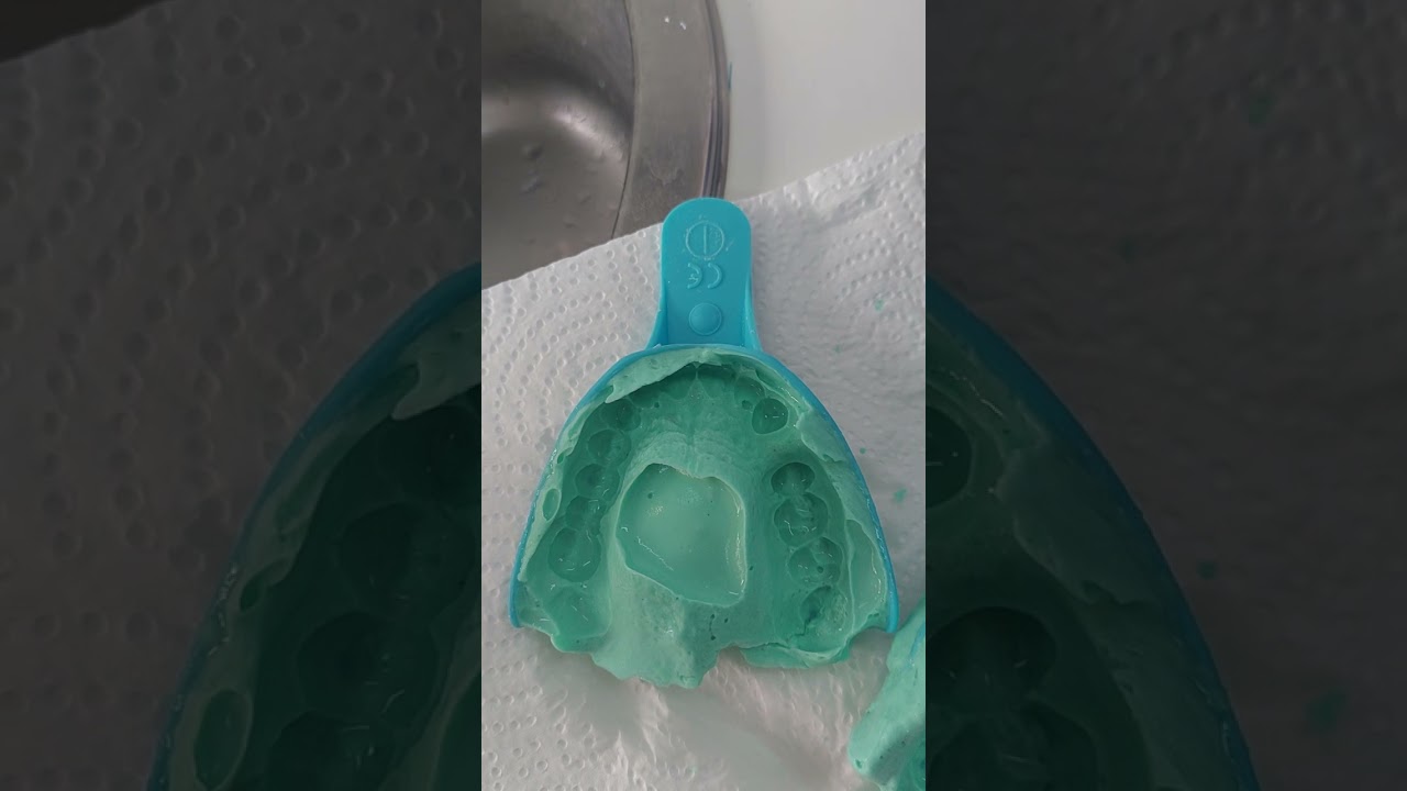 Visit 1 Upper impression options for a deep palatal vault