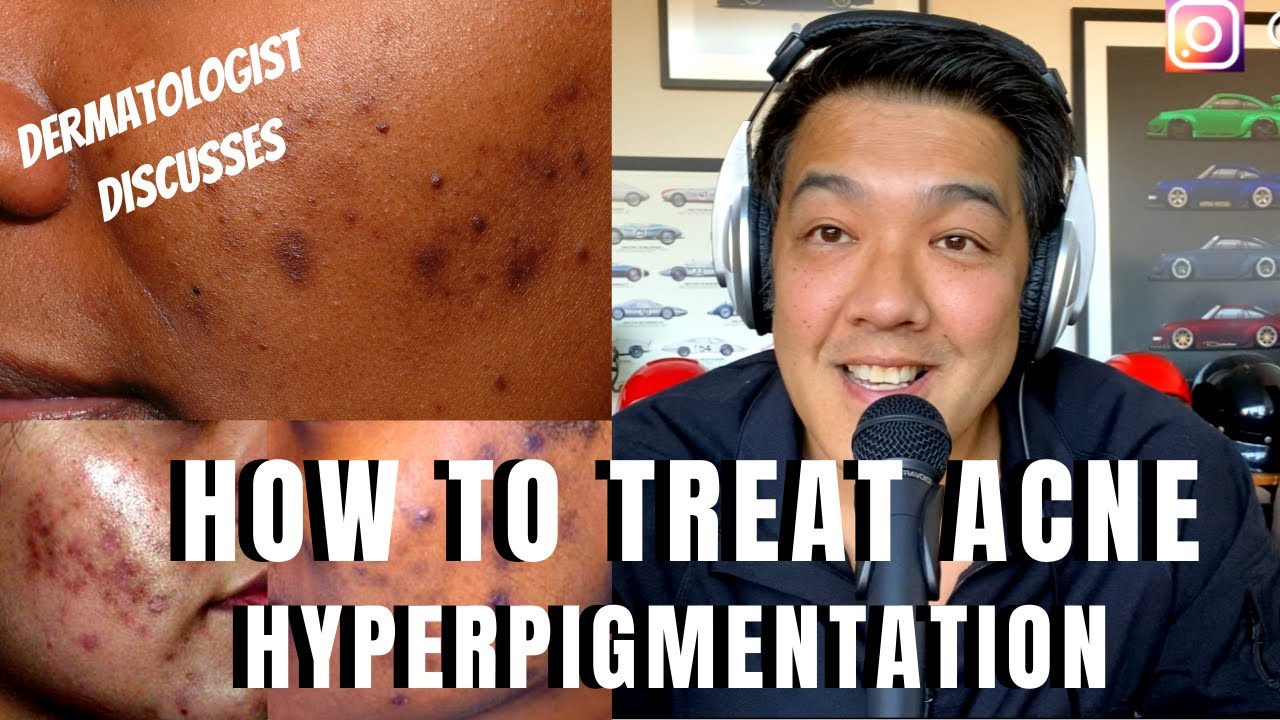 How to treat ACNE PIGMENTATION | PIH