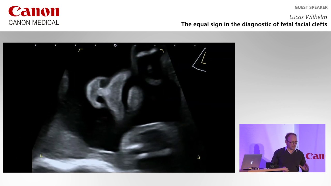 ISUOG  - Lucas Wilhelm on  the “equal sign” in the diagnosis of fetal facial clefts