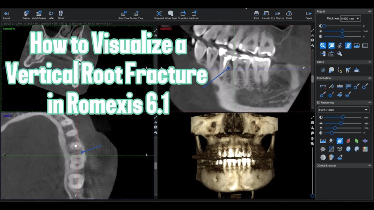 How to Visualize a Vertical Root Fracture in Romexis 6.1