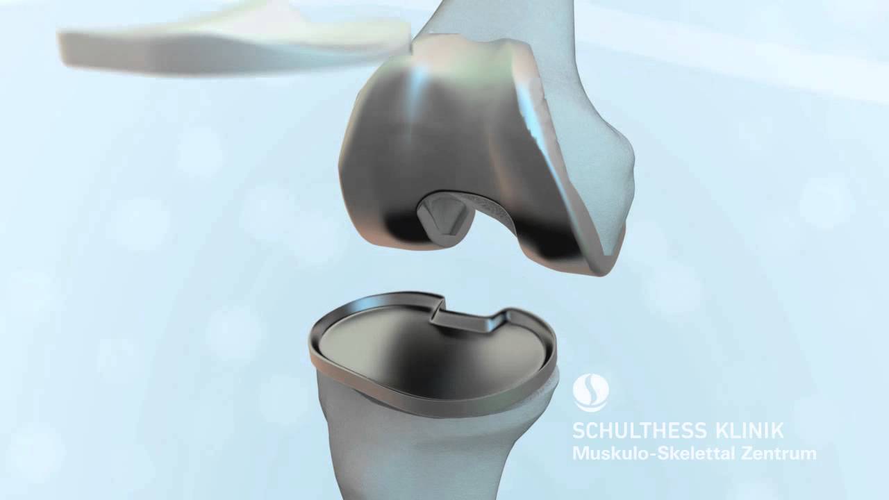 «Kniegelenk – Totalendoprothese» - Schulthess Klinik