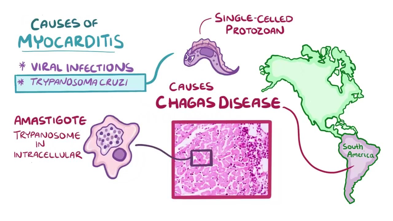 Myocarditis