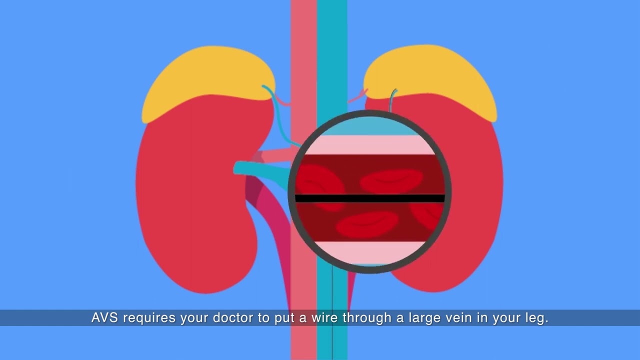 Primary Aldosteronism: identifying the abnormal adrenal gland (English)