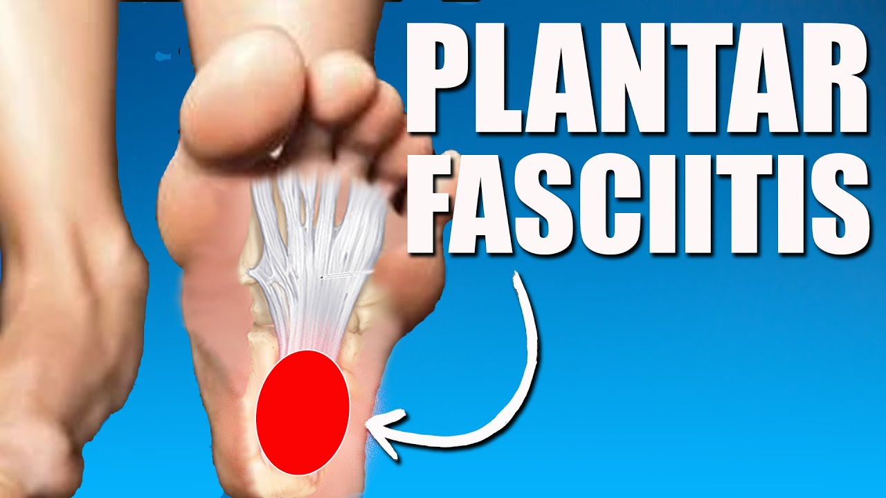Plantar Fasciitis l (Stretches l Exercise l Symptoms l Diagnosis)