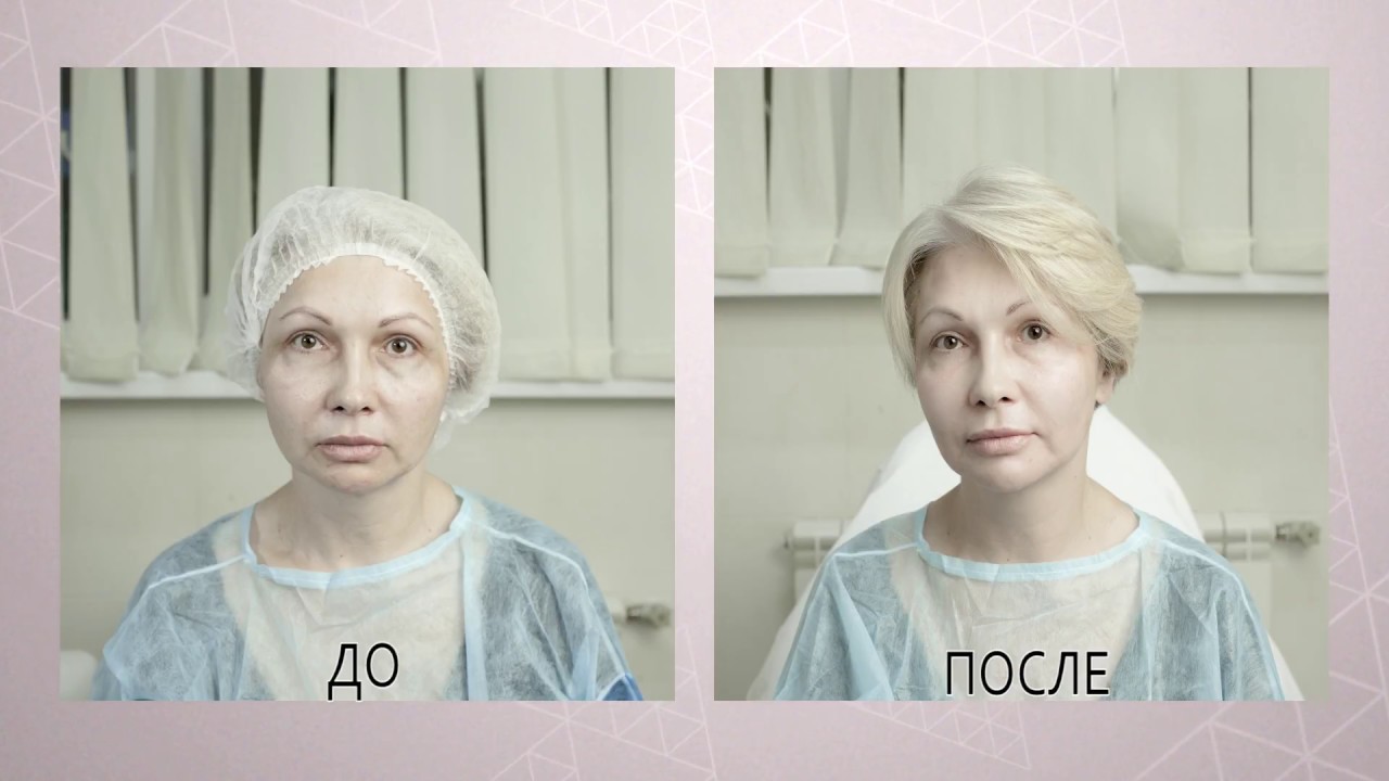 Бустеризация с помощью препарата TwAc