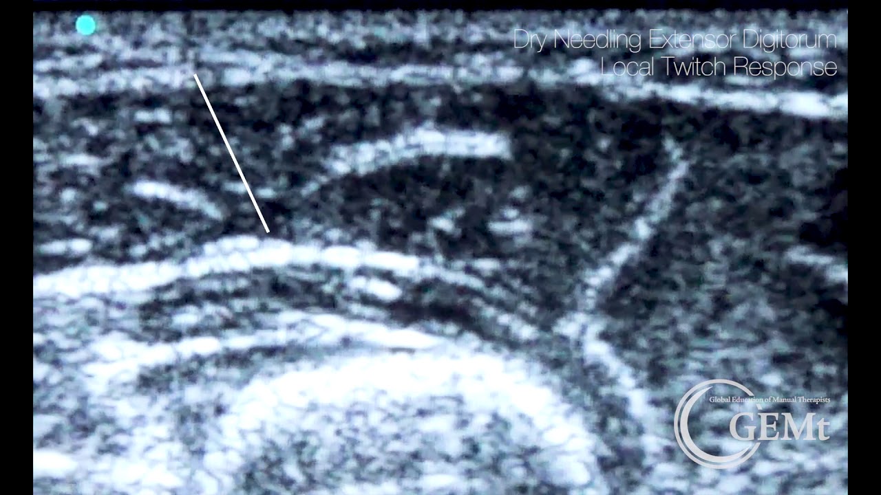Dry Needling Extensor Digitorum under ultrasound