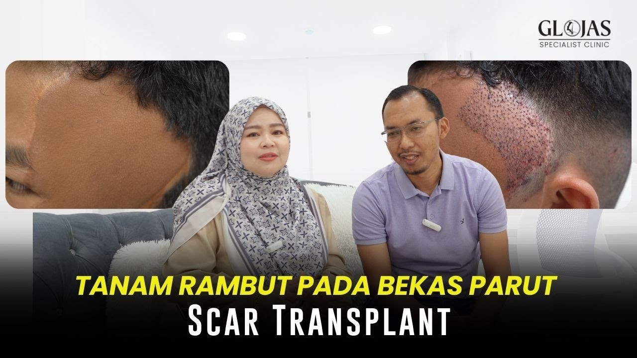 Tanam Rambut SMART™ FUE Atas Parut: Lihat Hasil Selepas 2 Minggu di GLOJAS!