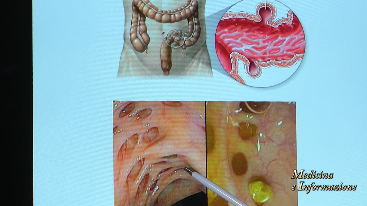 Diverticoli: perchè si formano, come si trattano