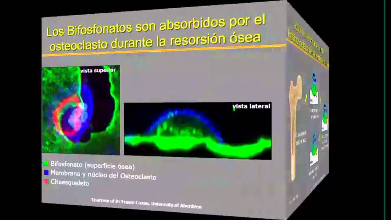 Tratamiento con Bifosfonatos, Osteoformadores y Terapias Secuenciales