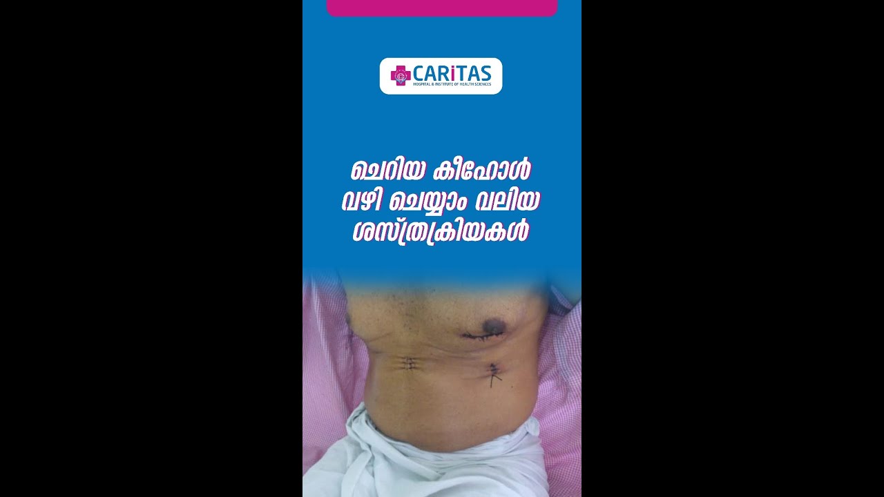 ചെറിയ കീഹോൾ വഴി ചെയ്യാം വലിയ ശസ്ത്രക്രിയകൾ  | Dr. Rajesh Ramankutty | Caritas Hospital