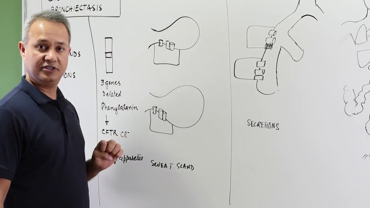 Аномалия потовых желез при муковисцидозе